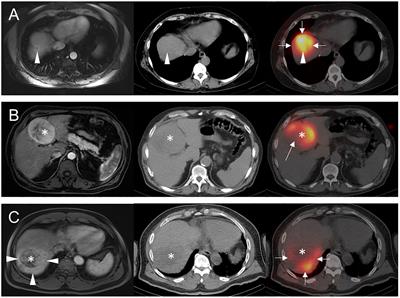 Arterial hypoperfusion as a negative predictive marker for primary hepatic malignancies treated with Y-90 glass microsphere transarterial radioembolization